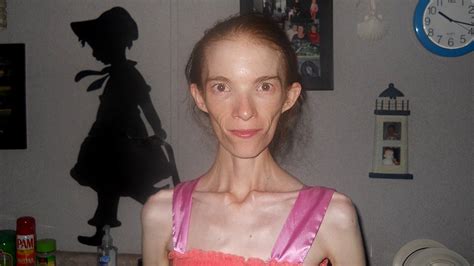 Anorexic girl takes her bikini off and poses. . Annorexic porn